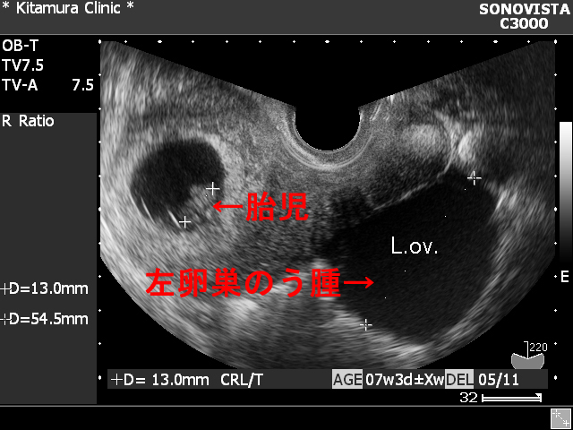 と われ た 卵巣 腫れ が てる 言 卵巣が腫れていると言われました。今回、5センチほど腫れているらしく、まえにも六センチ腫れて…