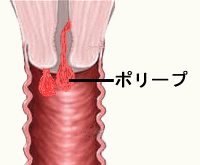 子宮 頚 管 ポリープ 悪性 だっ た