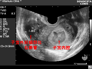 子宮外妊娠 症状